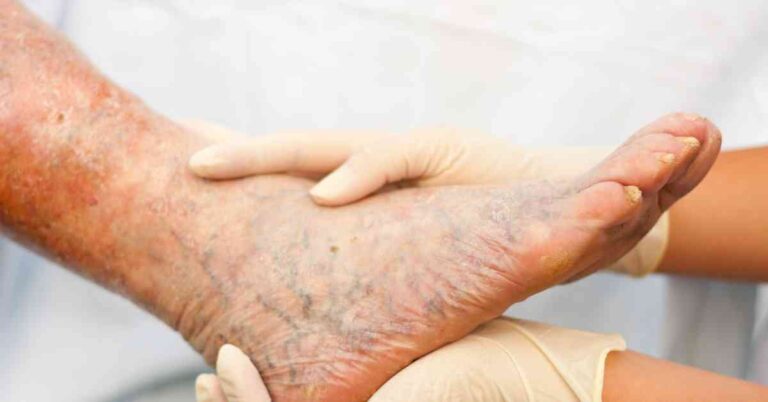 natural pain relief for varicose veins