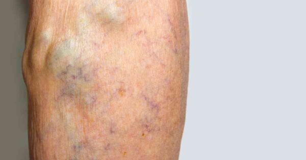 pain relief for varicose veins