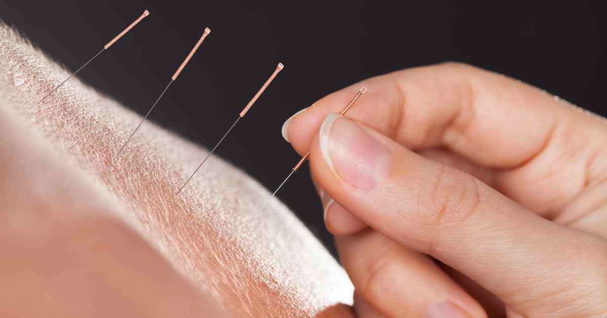 acupuncture for pain relief
