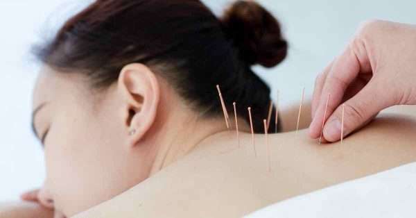 acupuncture for pain relief